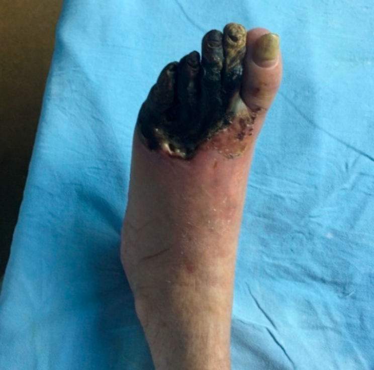 ডায়াবেটিক ফুট ও গ্যাংগ্রিন